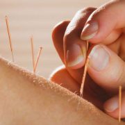 dry-needling-services